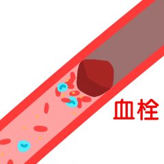 血栓で血管が詰まる