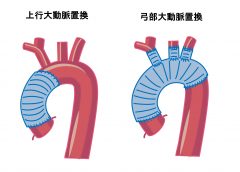 人口血管置換術