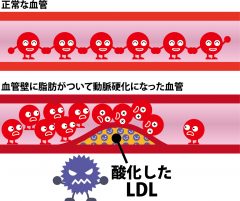 コレステロールがたまる